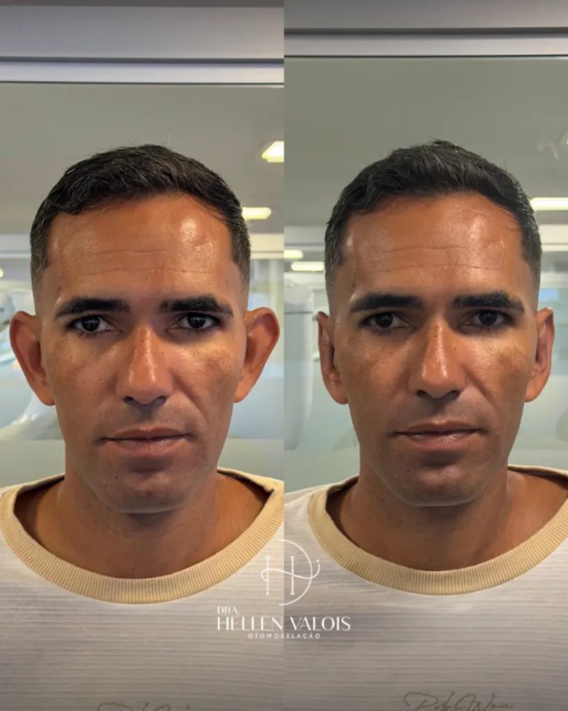 Antes e depois da orelha