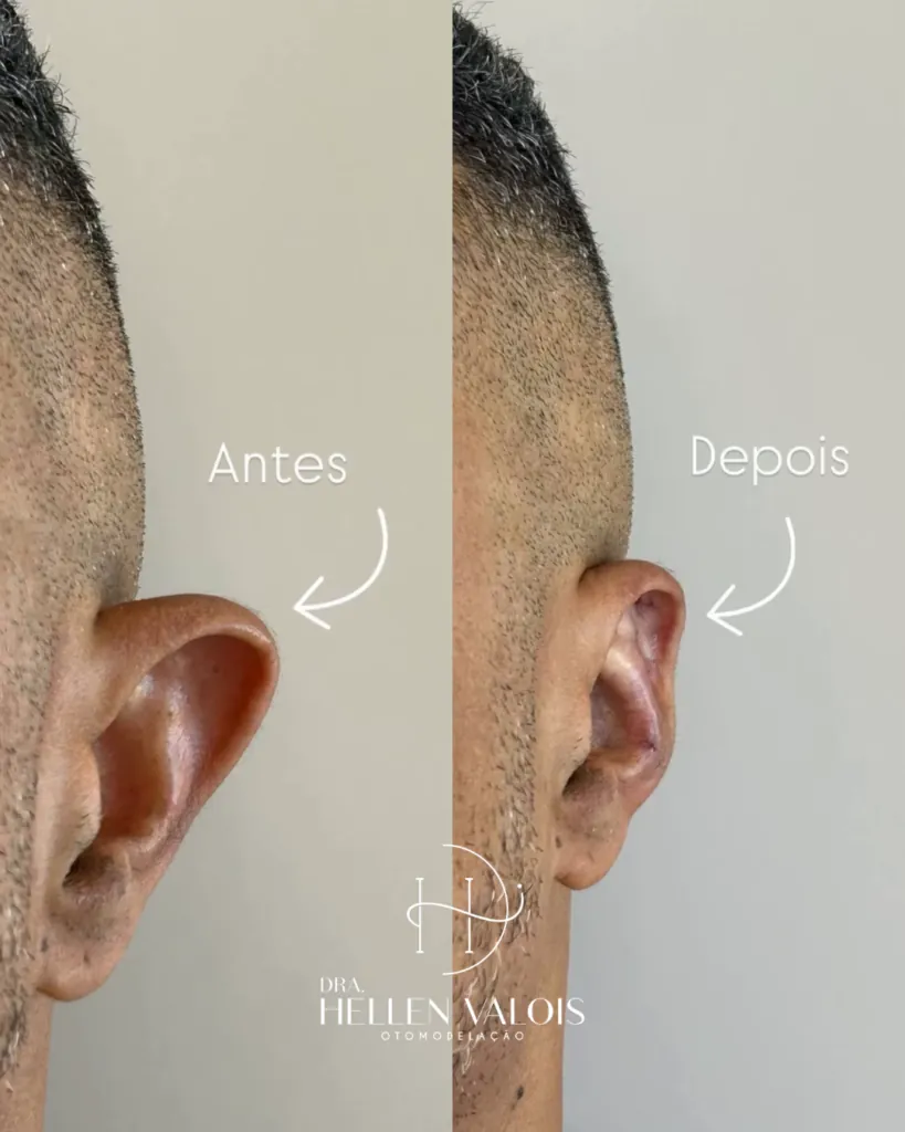 Resultado natural